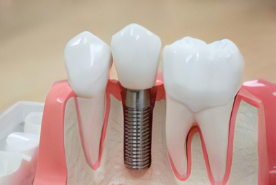 難症例のインプラント治療にも対応