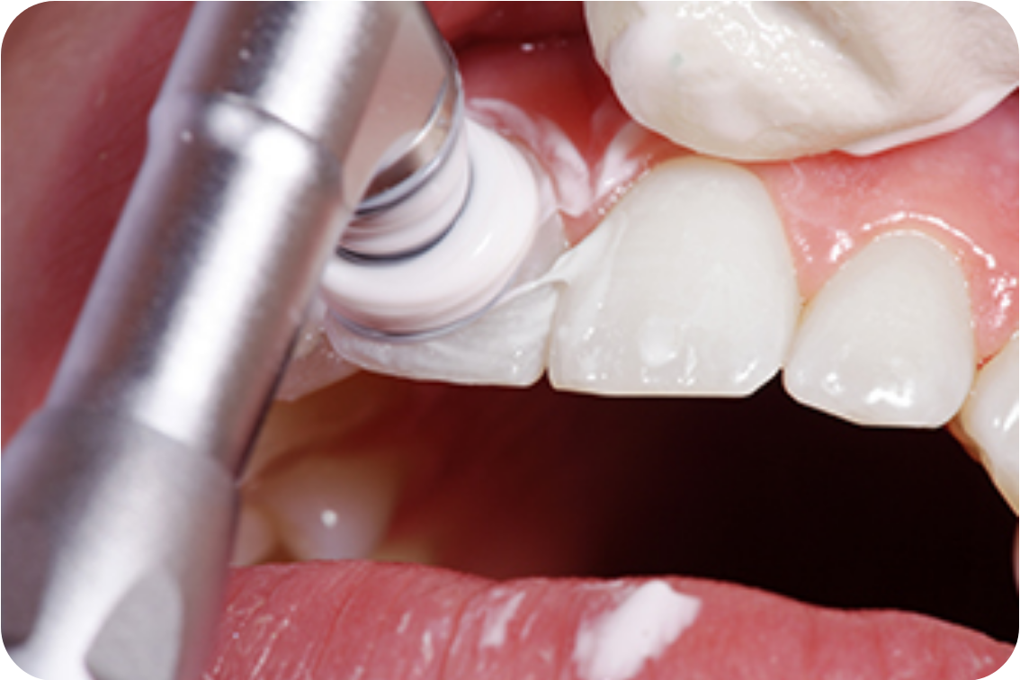 生活習慣の改善も虫歯や歯周病予防につながります。