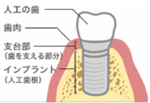 歯科用CTで的確な診断の上、治療いたします