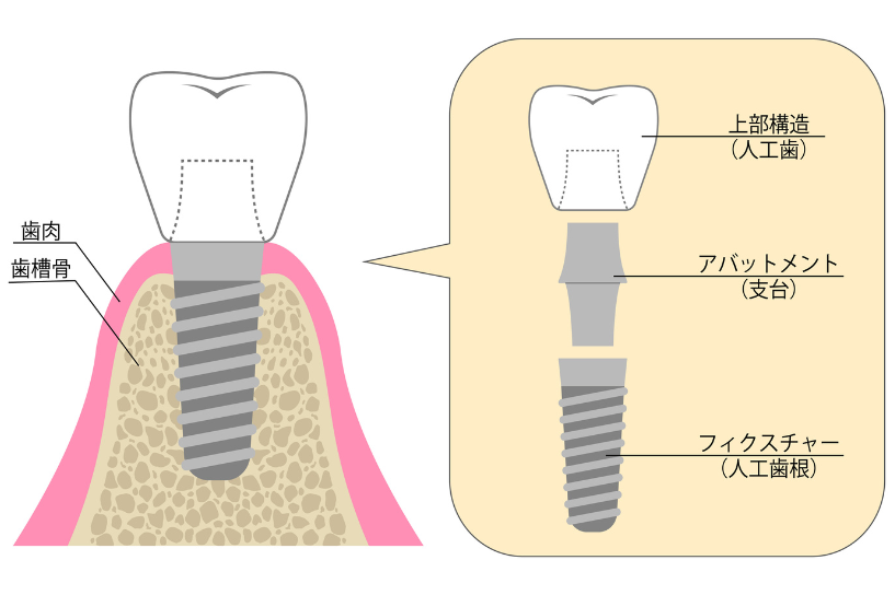 インプラントについて