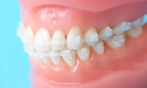 歯の色に近いセラミックブラケット