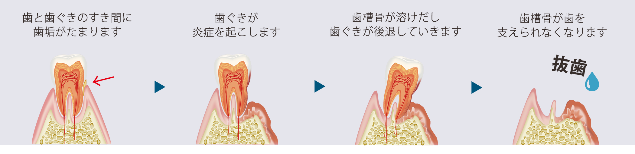 成人の約8割が歯周病に感染しているといわれています