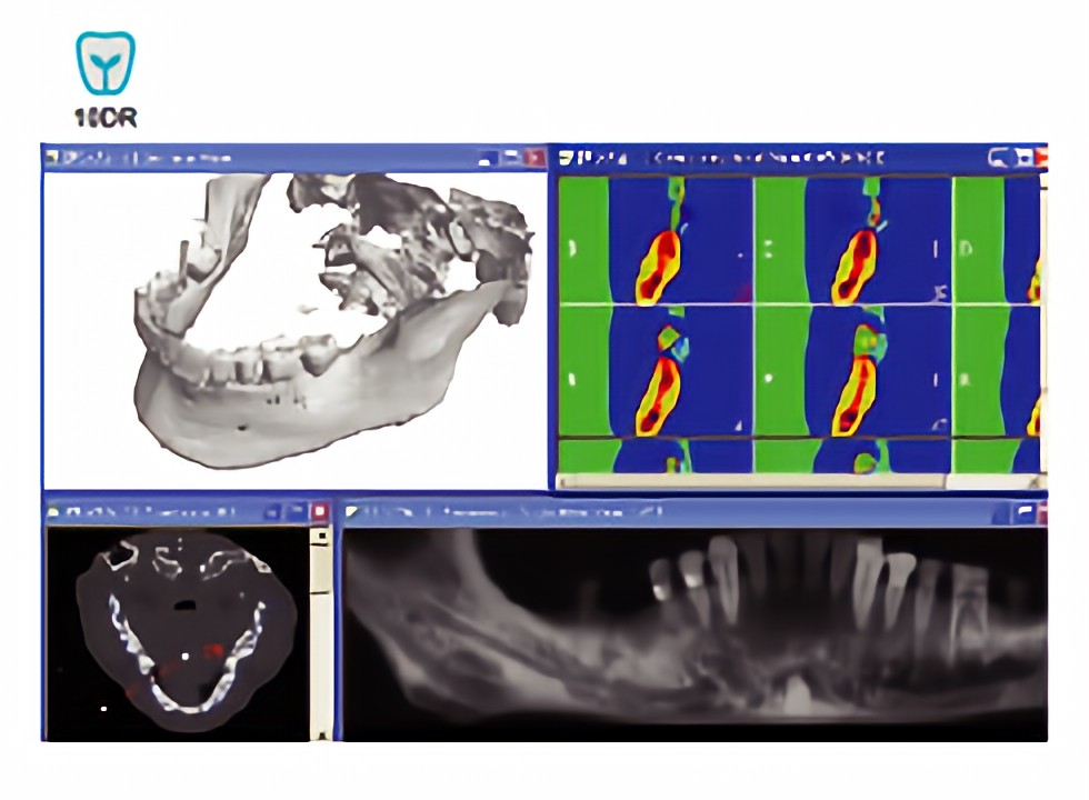 10DRインプラントシステムを導入
