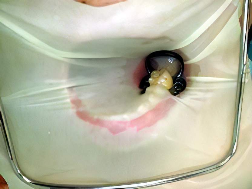 ラバーダム防湿法