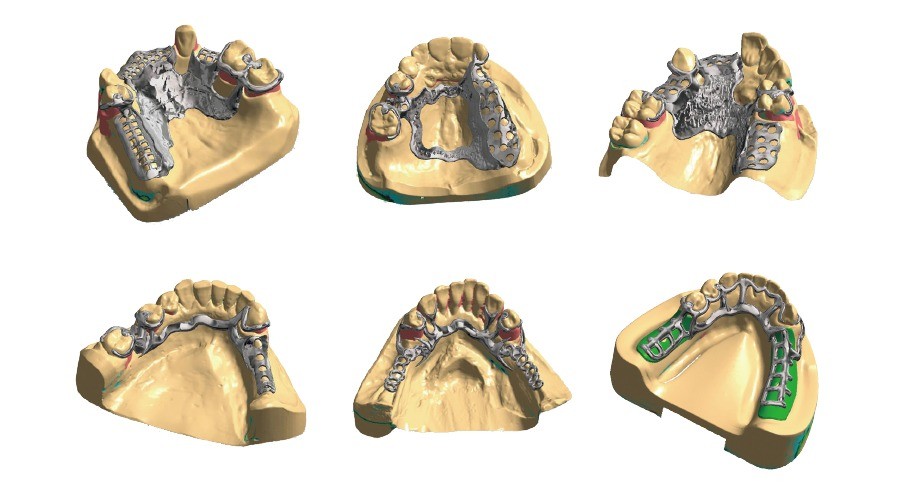 光学スキャナーでお口の中をスキャンし、3Dデータを作成します