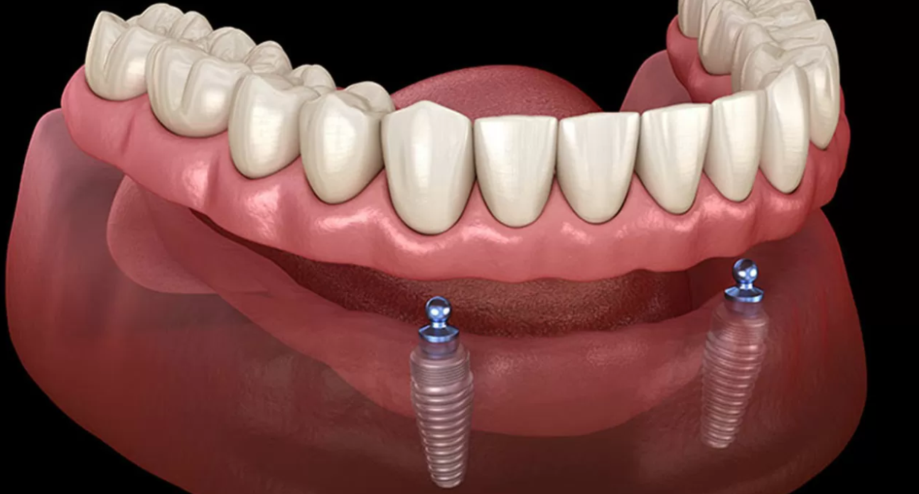あなたに合った入れ歯を