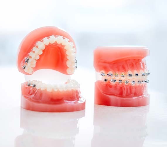 歯や顎の骨に適度な力を加えることで、整った歯並びとバランスのよいかみ合わせを目指します。