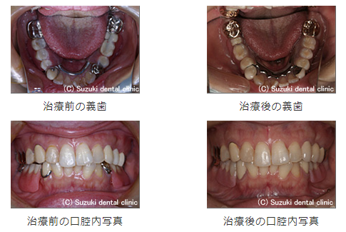 快適な入れ歯で食事や会話が楽しめます