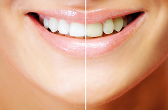 自然な見た目と耐久性を兼ね備えた素材で自信ある笑顔を取り戻す