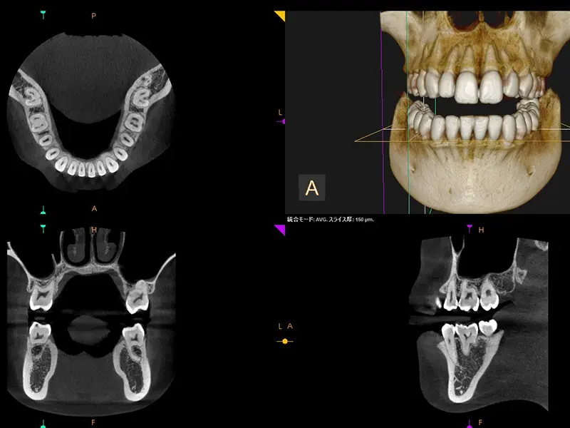 噛み応えや見た目の自然さにこだわったインプラント治療を提供している