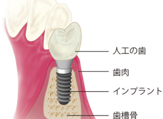 歯を失ってお悩みの方はぜひ一度ご相談ください