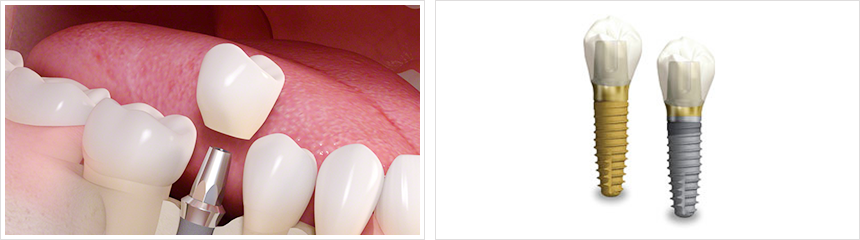 安全性を最優先にしたインプラント治療を提供しています