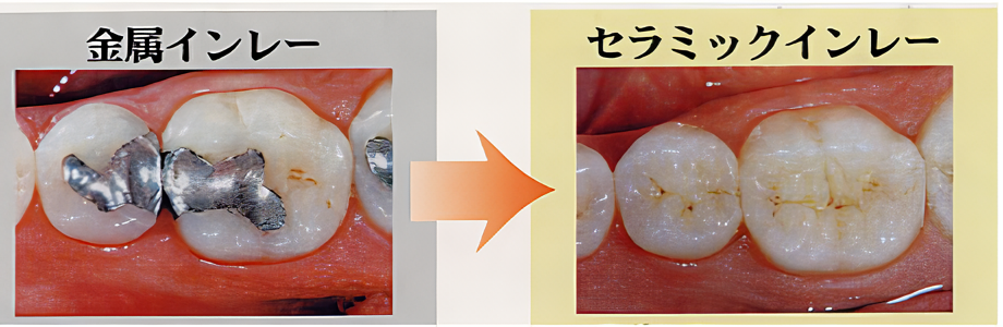 審美的な補綴も得意としています