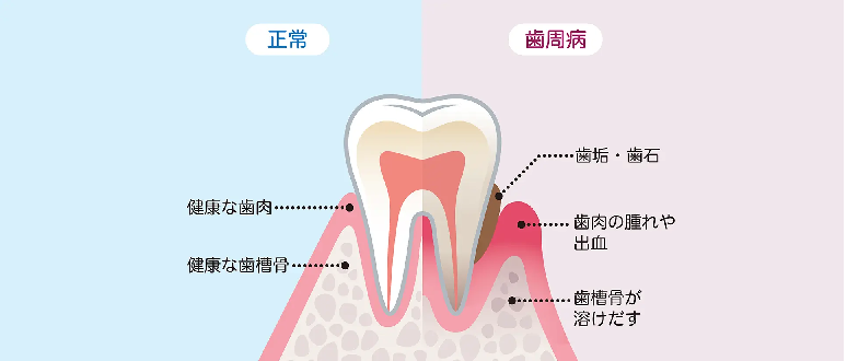 早めのケアが歯を守る鍵