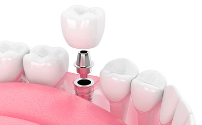 噛める喜びをもう一度