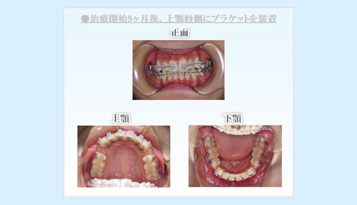 日本矯正歯科学会認定医による短期間・低負担の矯正治療