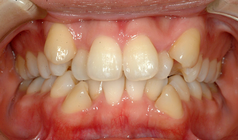 ガタガタな歯ならびは、顎関節に異常がなければ比較的容易に治せます。