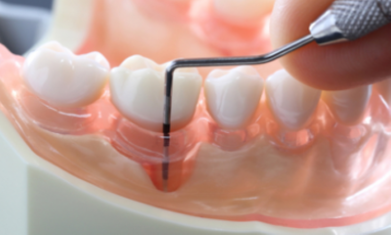 美しさと機能性を兼ね備えたセラミック治療