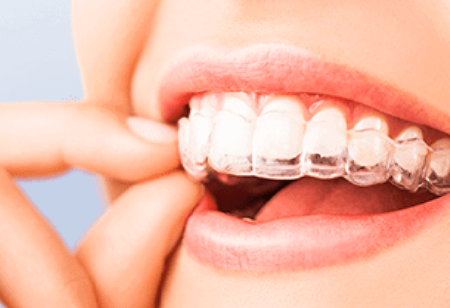 最新デジタル矯正治療 要約:iTeroとCTを活用した精密な矯正診療を提供