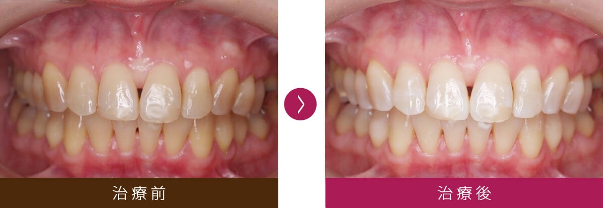 生活に合わせたホワイトニングの方法を選べます