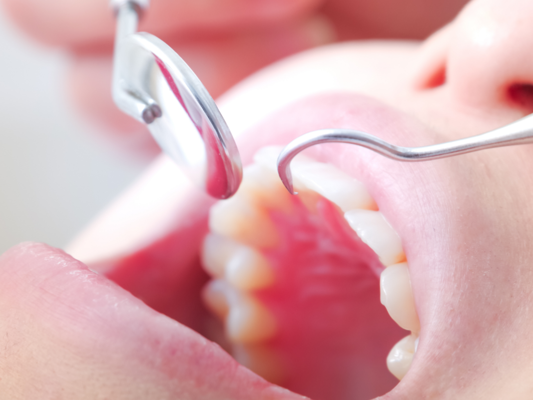 インプラントで綺麗な歯を