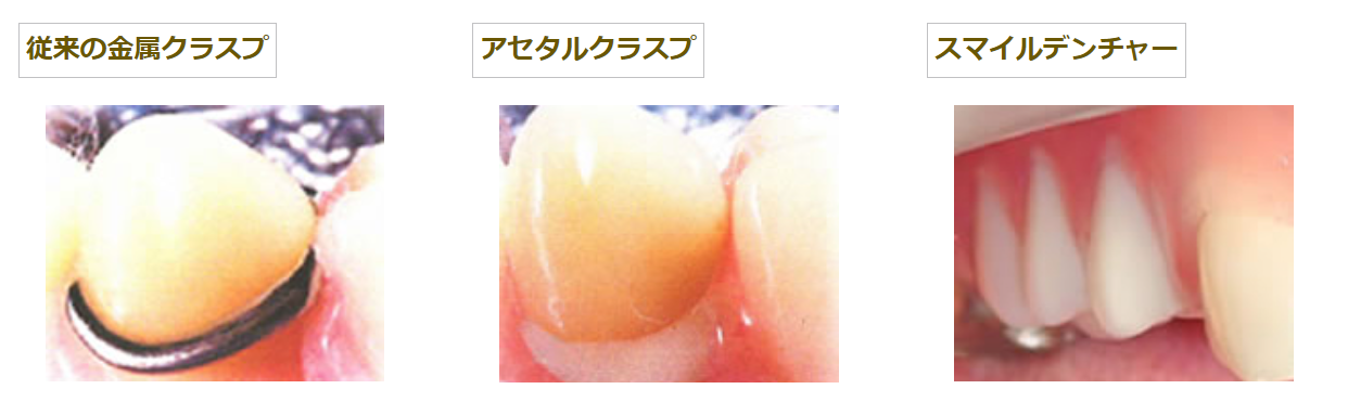 金属を使わない入れ歯もあります