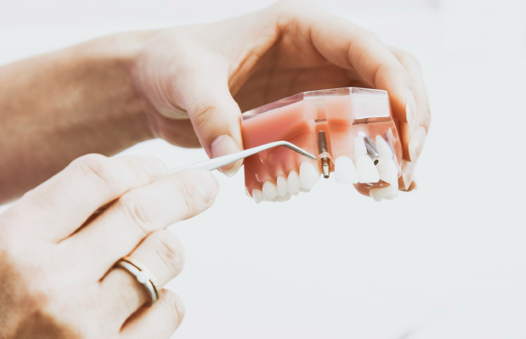 安心と快適を提供する歯科インプラントのご提案