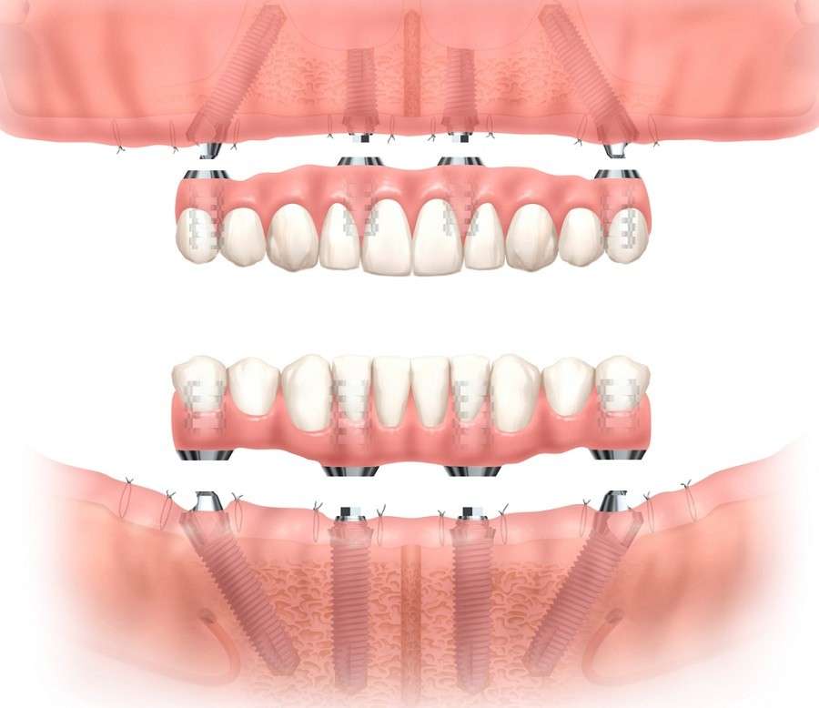 オールオン４（All-on-4）のイメージ図