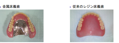 金属床義歯と従来のレジン床義歯