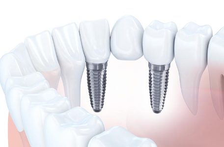 インプラントにご興味がある方は、ぜひお気軽にご相談ください。
