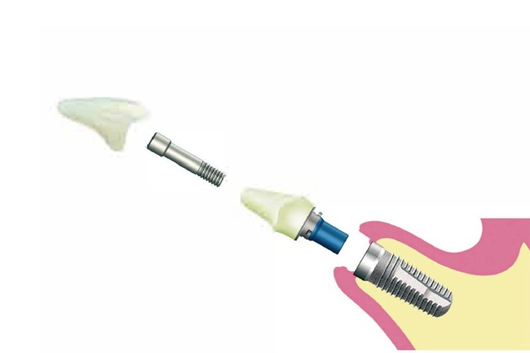 細部までこだわったインプラント治療で、自然な噛み心地を目指す