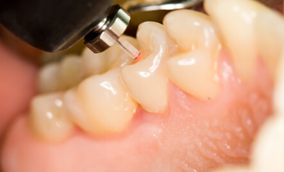 虫歯や歯周病等の治療でレーザーを用いています