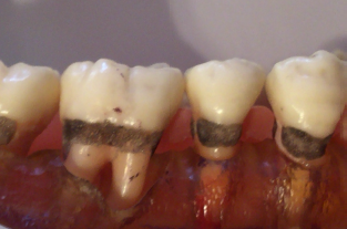 歯周病の進行を防ぎ、未来の健康を守る