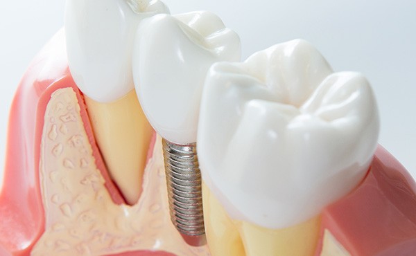 患者様の将来を見据え、安心して選択できる治療として丁寧にサポートしています。