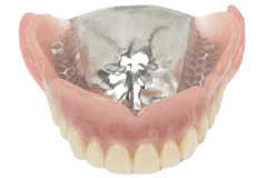 金属床の入れ歯
