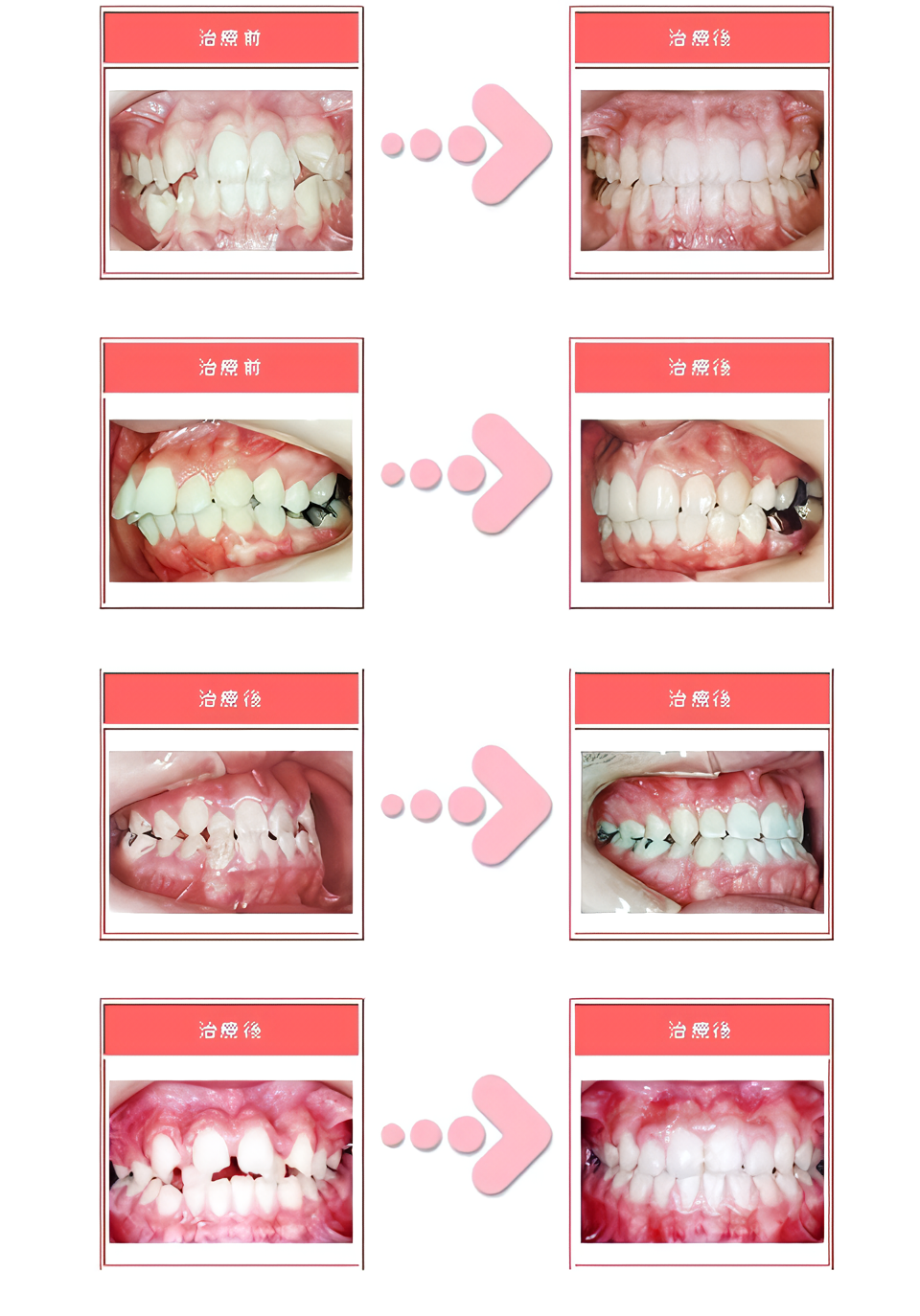 小児でも大人でも矯正可能です