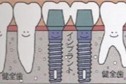 隣の歯を削りたくない方や取り外し式の入れ歯が気になる方に適した選択肢です