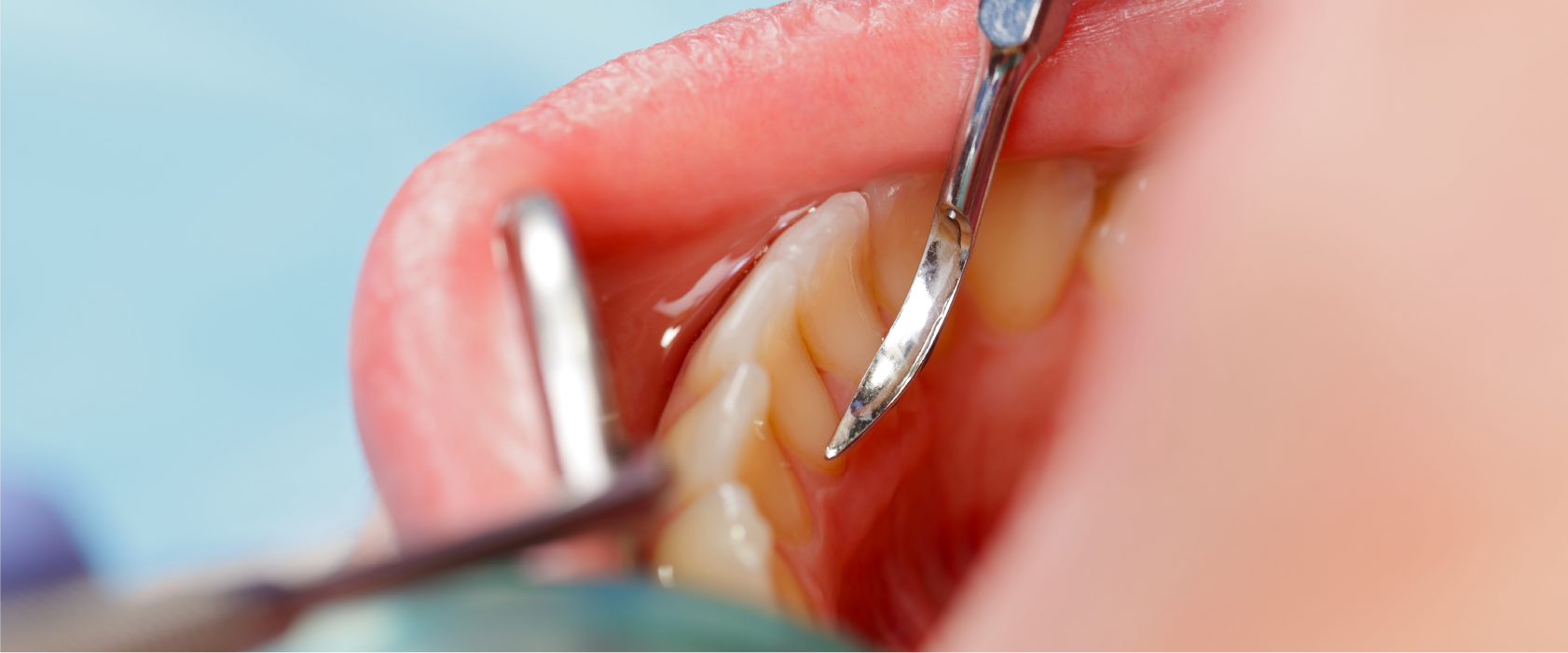 日本歯科医師のうち歯周病専門医が1％しかいない中、大船駅北口歯科には2名の日本歯周病学会歯周病専門医が在籍しています