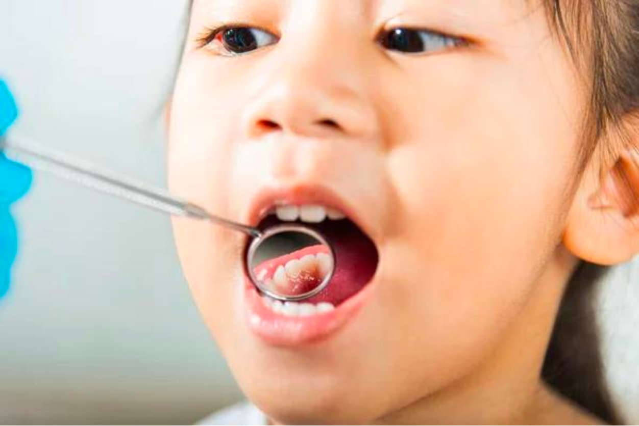 フッ素塗布やシーラントなどの予防も行っています