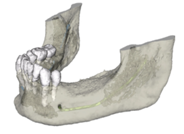CTを活用したインプラント治療を行っています
