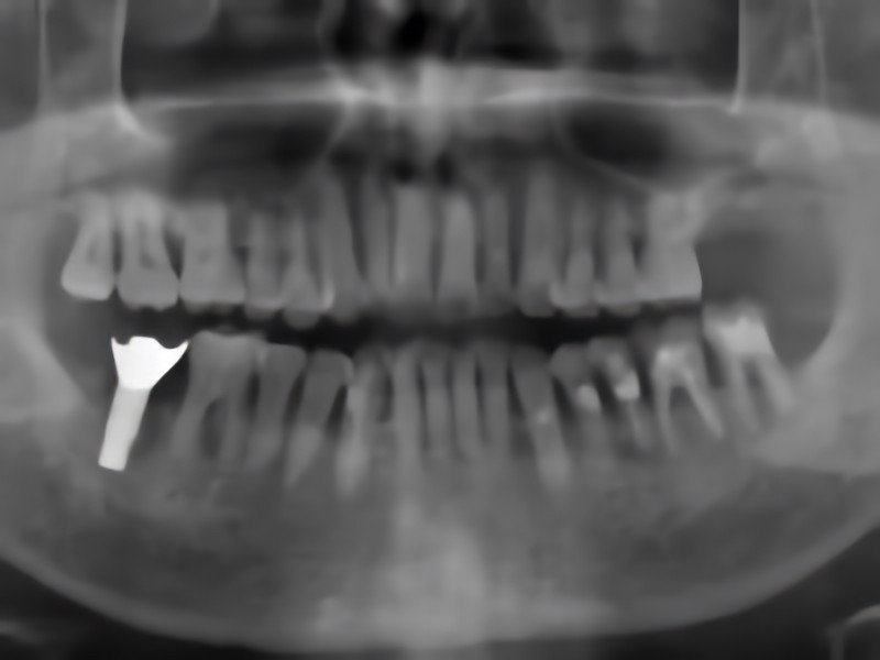 治療後のレントゲン写真