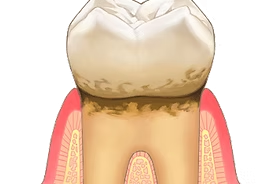 歯ぐきの腫れや出血が気になる方は早めの相談がおすすめ