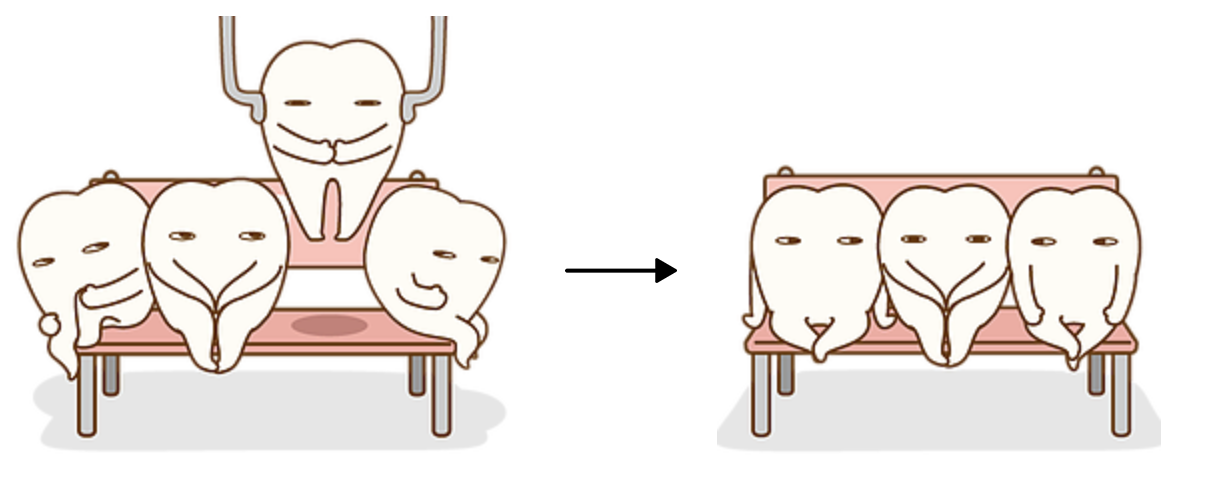 抜歯イメージ画像