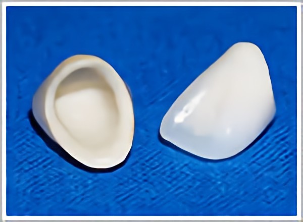 オールセラミッククラウン・インレー