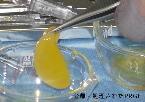 再生歯科医療PRGFに対応可