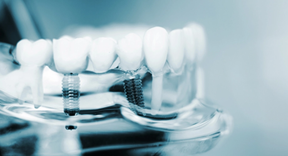 インプラントのイメージ