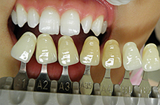 ホワイトニングで見た目が全く変わります