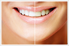 「オフィスホワイトニング」と「ホームホワイトニング」の2種類ご用意します