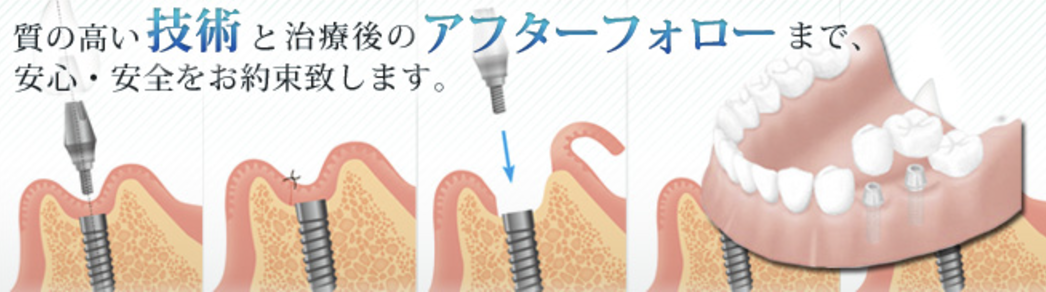 インプラント治療を提供し、患者様が快適に日常生活を送れるようサポートしています