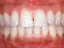 歯周炎はお口の中の細菌が引き起こす口腔内二大疾患の一つです